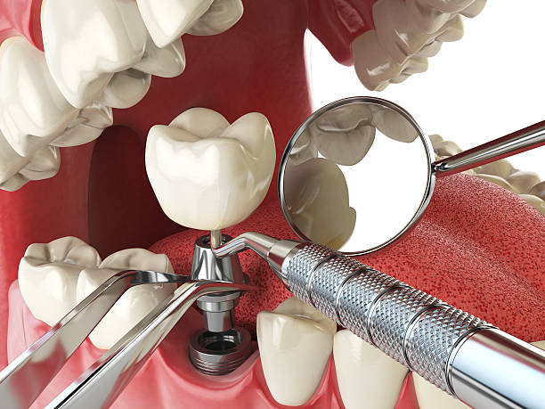 Best Emergency Denture Repair in Monrovia, CA